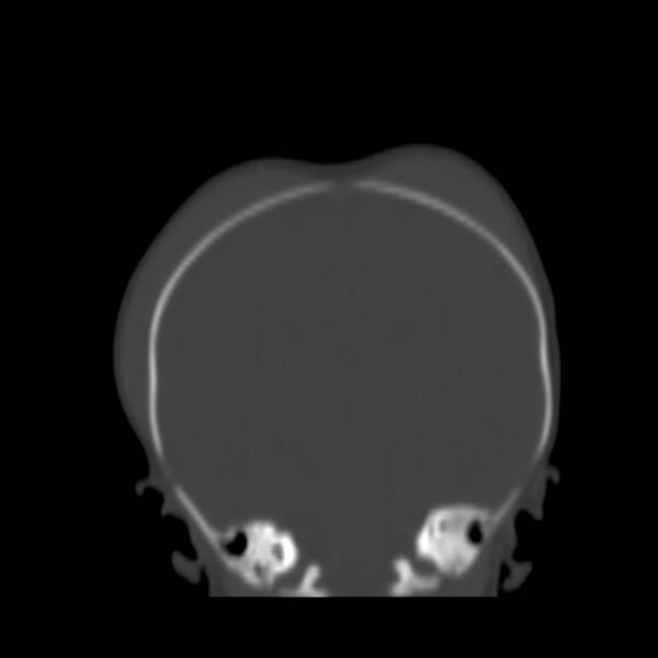 File:Bilateral cephalohematomas and subdural hematomas (Radiopaedia 26778-26929 Coronal bone window 16).jpg