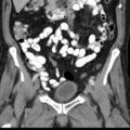 Bilateral direct inguinal herniae (Radiopaedia 17016-16719 A 16).jpg