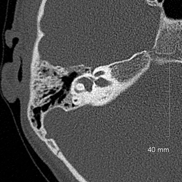 File:Bilateral grommets (Radiopaedia 47710-52404 Axial bone window 43).jpg