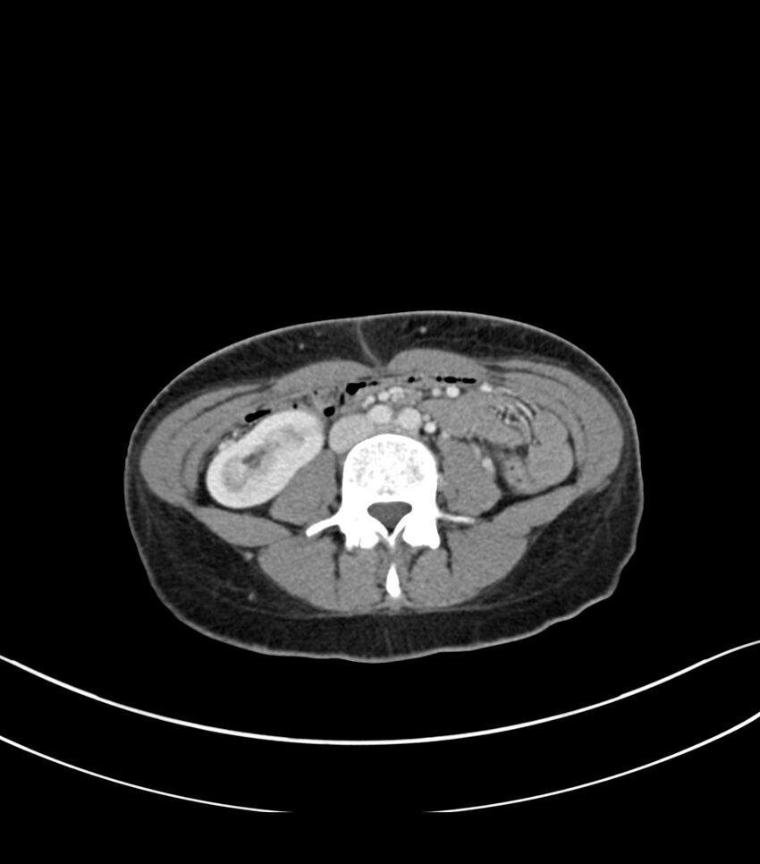 Bilateral kidney malrotation (Radiopaedia 72227-82749 A 38).jpg