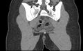 Bilateral mature cystic ovarian teratoma (Radiopaedia 88821-105592 Coronal non-contrast 33).jpg