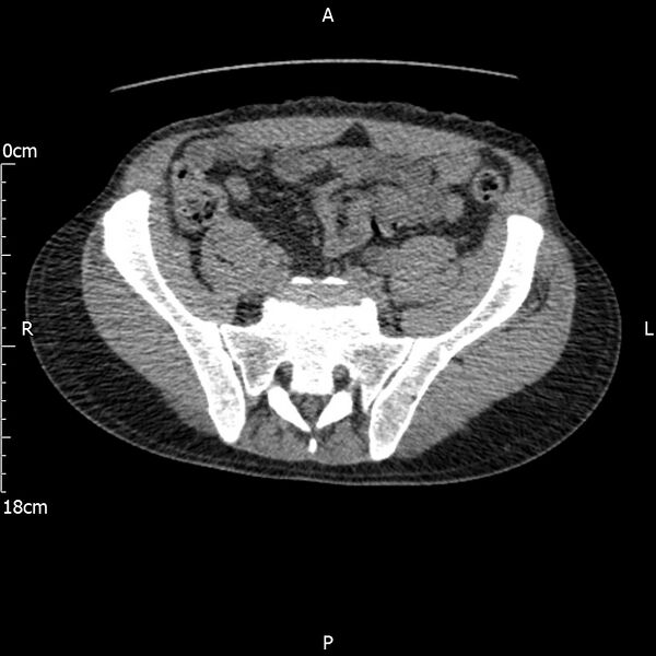 File:Bilateral medullary nephrocalcinosis with ureteric calculi (Radiopaedia 71269-81569 Axial non-contrast 97).jpg