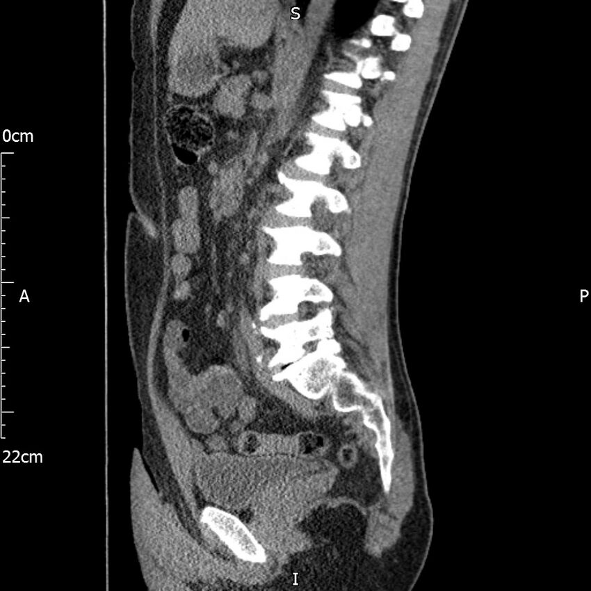 Bilateral medullary nephrocalcinosis with ureteric calculi (Radiopaedia 71269-81569 C 53).jpg