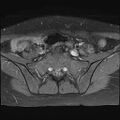 Bilateral ovarian endometriomas (Radiopaedia 87085-103347 Axial T1 C+ fat sat 2).jpg