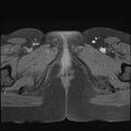 Bilateral ovarian endometriomas (Radiopaedia 87085-103347 Axial T1 fat sat 24).jpg