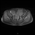 Bilateral ovarian fibroma (Radiopaedia 44568-48293 Axial T1 C+ fat sat 11).jpg