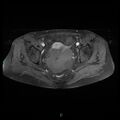 Bilateral ovarian fibroma (Radiopaedia 44568-48293 Axial T1 C+ fat sat 17).jpg