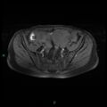 Bilateral ovarian fibroma (Radiopaedia 44568-48293 Axial T1 fat sat 9).jpg