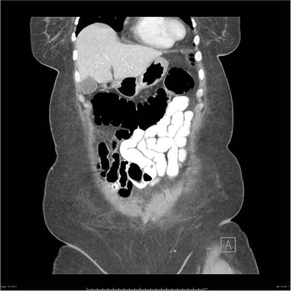 File:Bilateral psoas hematomas (Radiopaedia 24057-24279 B 15).jpg