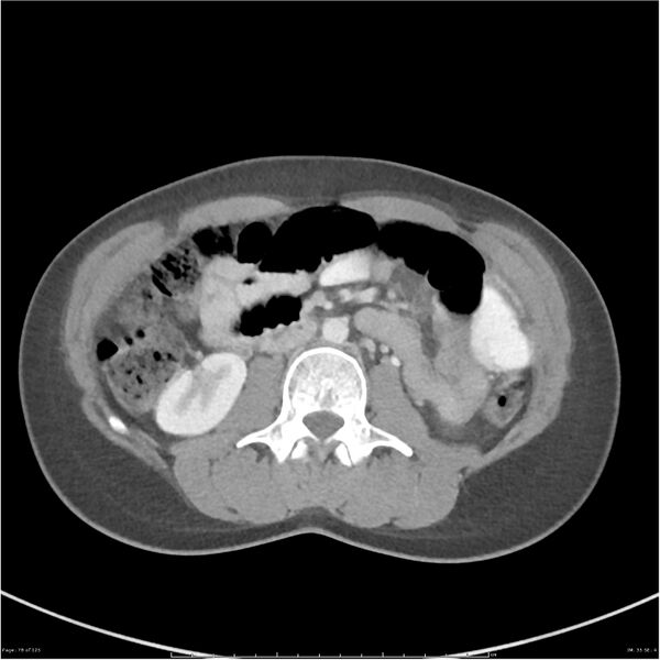 File:Bilateral ureteritis and cystitis (Radiopaedia 25340-25594 A 35).jpg