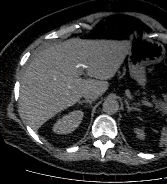 File:Bile leak from accessory duct(s) of Luschka post cholecystectomy (Radiopaedia 40736-43389 A 17).jpg