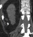 Bile leak from accessory duct(s) of Luschka post cholecystectomy (Radiopaedia 40736-43389 B 62).jpg