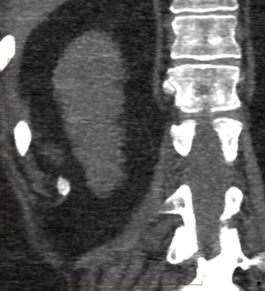 File:Bile leak from accessory duct(s) of Luschka post cholecystectomy (Radiopaedia 40736-43389 B 62).jpg