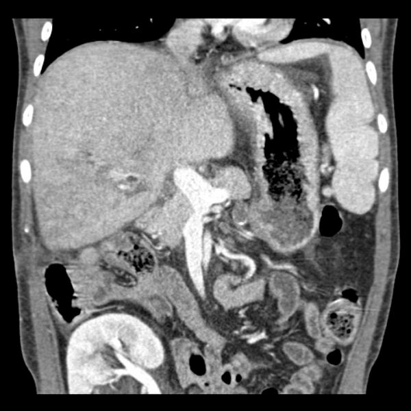 File:Biliary necrosis - liver transplant (Radiopaedia 21876-21846 C 22).jpg