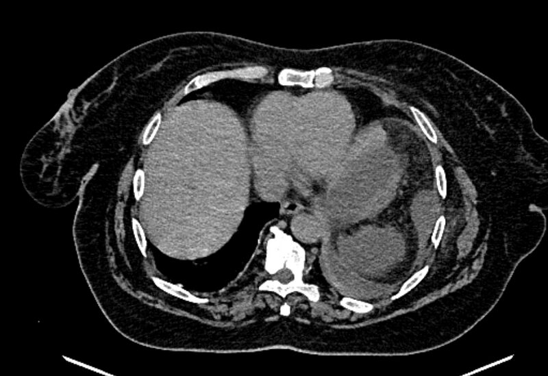 File:Biliary pancreatitis (Radiopaedia 72289-82823 Axial non-contrast 30).jpg