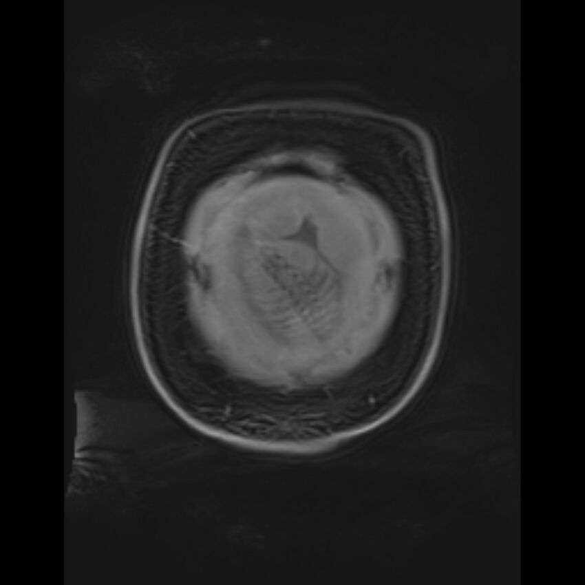 Bilobed placenta accreta (Radiopaedia 69648-79591 Coronal T1 vibe 16).jpg