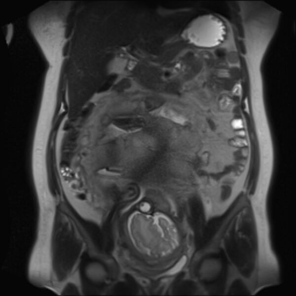 File:Bilobed placenta accreta (Radiopaedia 69648-79591 Coronal T2 21).jpg