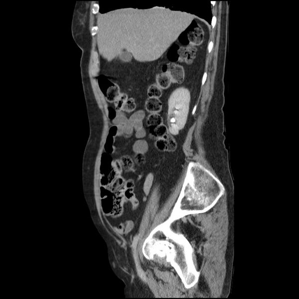 File:Bladder tumor detected on trauma CT (Radiopaedia 51809-57609 E 55).jpg