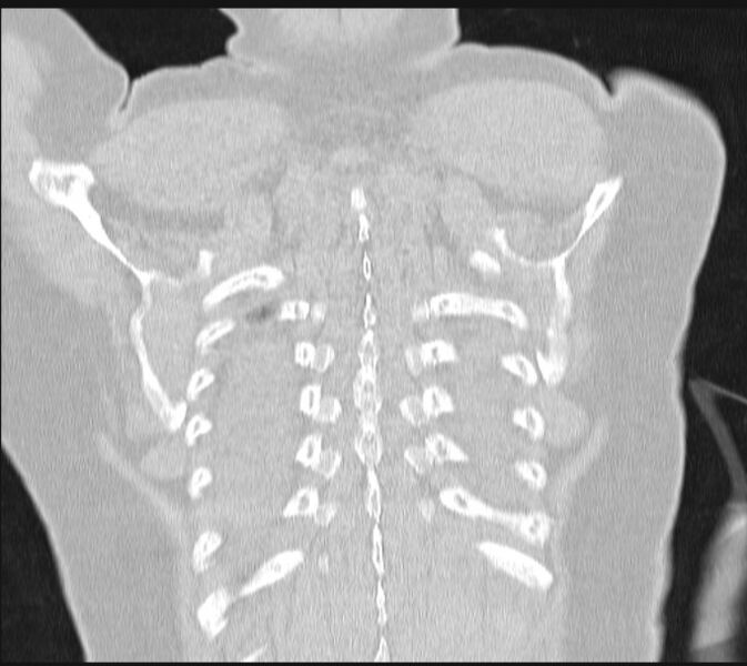 File:Boerhaave syndrome (Radiopaedia 45644-49799 Coronal lung window 63).jpg