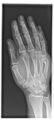 Boxer fracture (Radiopaedia 11249-11613 B 1).jpg