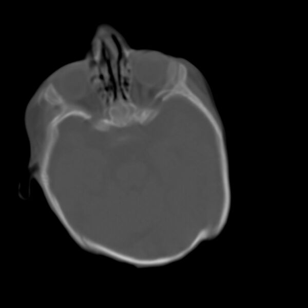 File:Brachycephaly (bi-coronal and bi-lambdoid synostosis) (Radiopaedia 55048-61413 Axial bone window 2).jpg