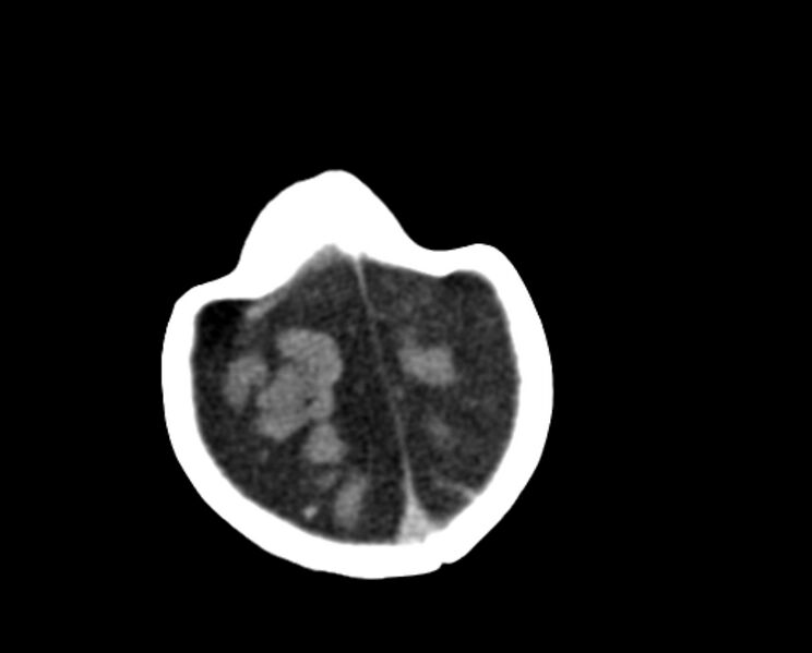 File:Brachycephaly (bi-coronal and bi-lambdoid synostosis) (Radiopaedia 55048-61413 Axial non-contrast 49).jpg