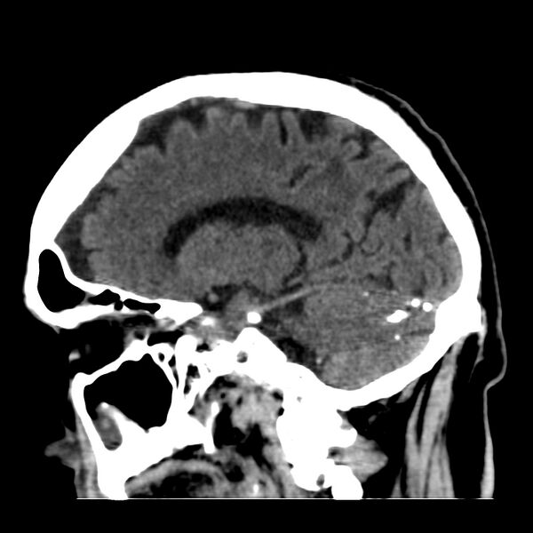 File:Brain Pantopaque remnants (Radiopaedia 78403-91048 C 23).jpg