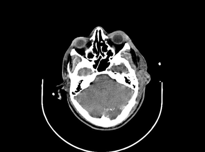 File:Brain injury by firearm projectile (Radiopaedia 82068-96087 B 68).jpg