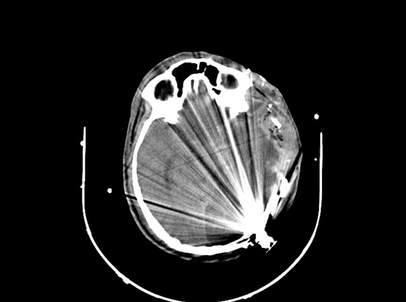 File:Brain injury by firearm projectile (Radiopaedia 82068-96087 B 94).jpg