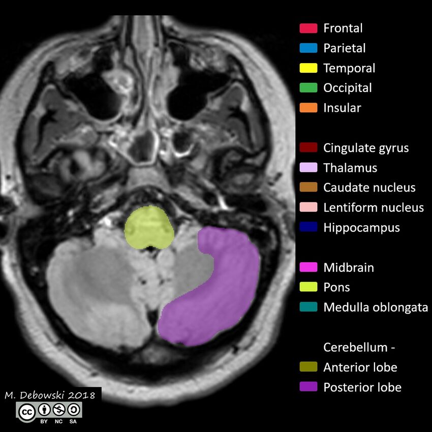 Brain lobes - annotated MRI (Radiopaedia 61691-69700 Axial 64).JPG
