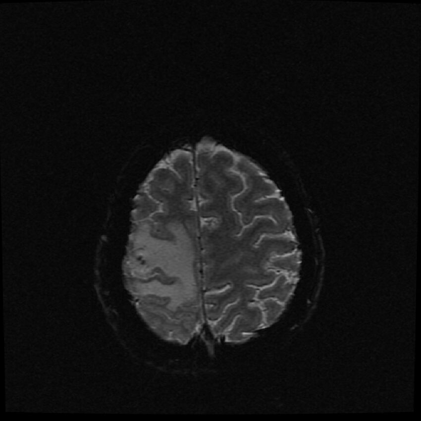 Brain metastases (renal cell carcinoma) (Radiopaedia 42571-45704 Axial SWI 6).jpg