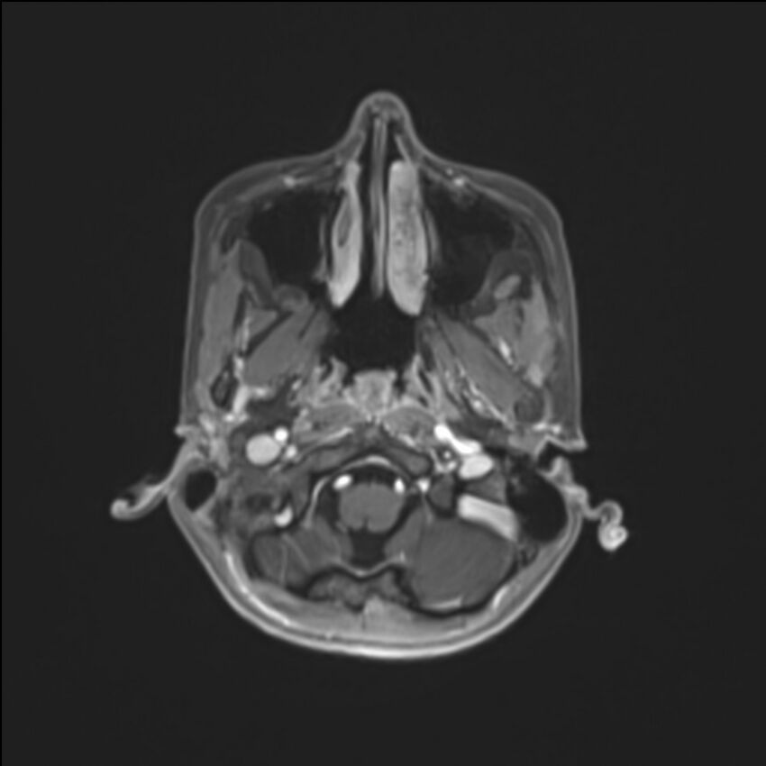 Brainstem glioma (Radiopaedia 70548-80674 Axial T1 C+ 24).jpg