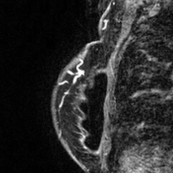 File:Breast implants - MRI (Radiopaedia 26864-27035 Sagittal T2 85).jpg