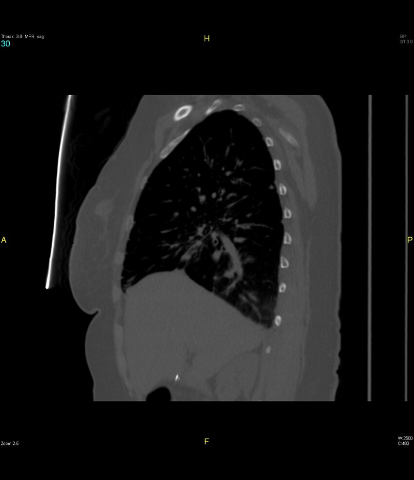Breast primary with lung and bone metastases (Radiopaedia 40620-43228 Sagittal bone window 30).jpg