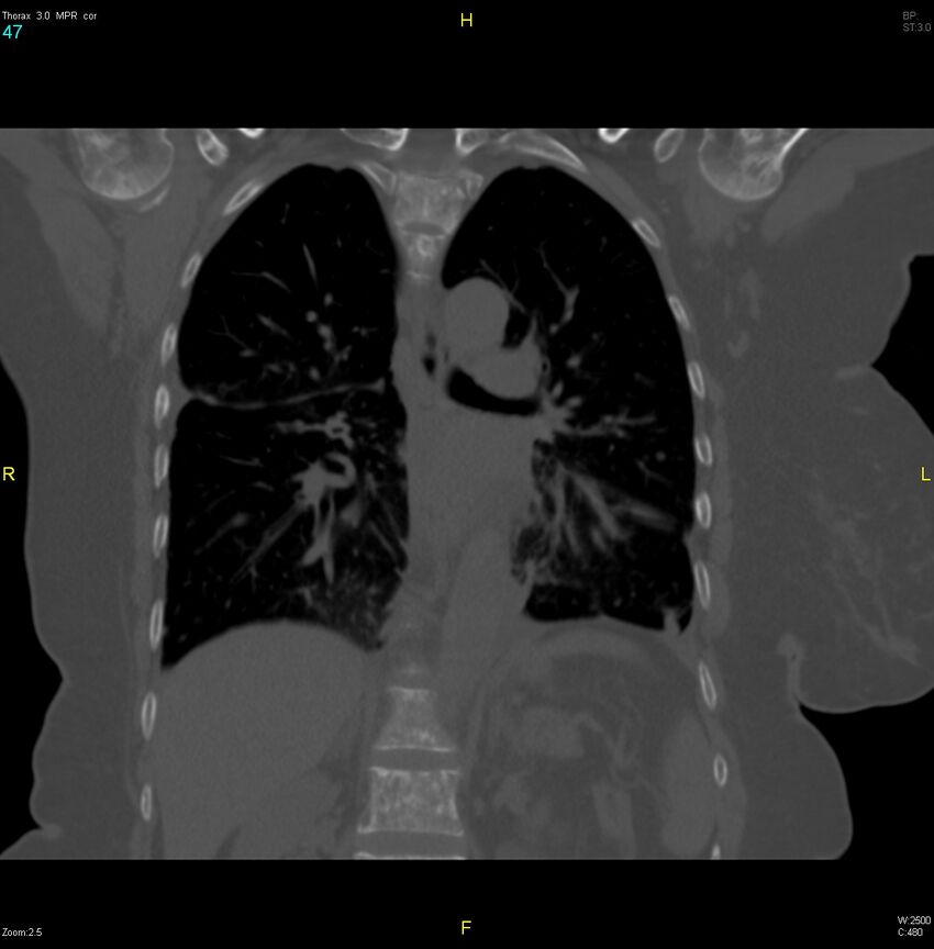 Breast primary with lung and bone metastases (Radiopaedia 40620-43228 bone window 47).jpg