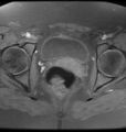 Broad ligament leiomyoma (Radiopaedia 81634-95516 Axial T1 fat sat 19).jpg