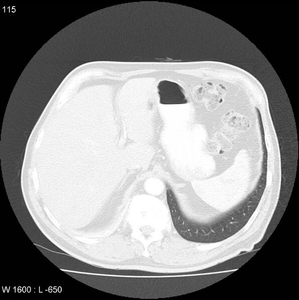 File:Bronchial carcinoid tumor with right lower lobe collapse (Radiopaedia 29060-29422 B 53).jpg
