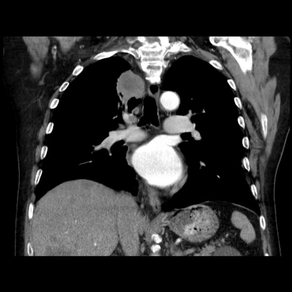 File:Bronchogenic adenocarcinoma and pulmonary embolism (Radiopaedia 9097-9806 C 28).jpg