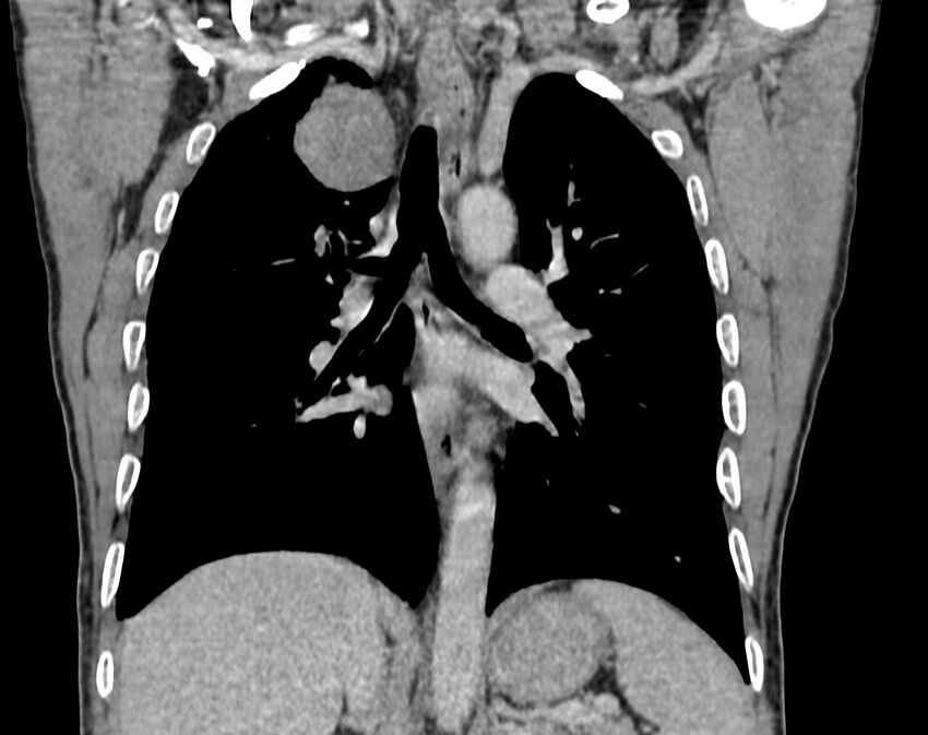 Bronchogenic carcinoma with superior vena cava syndrome (Radiopaedia 36497-38054 Coronal C+ delayed 59).jpg