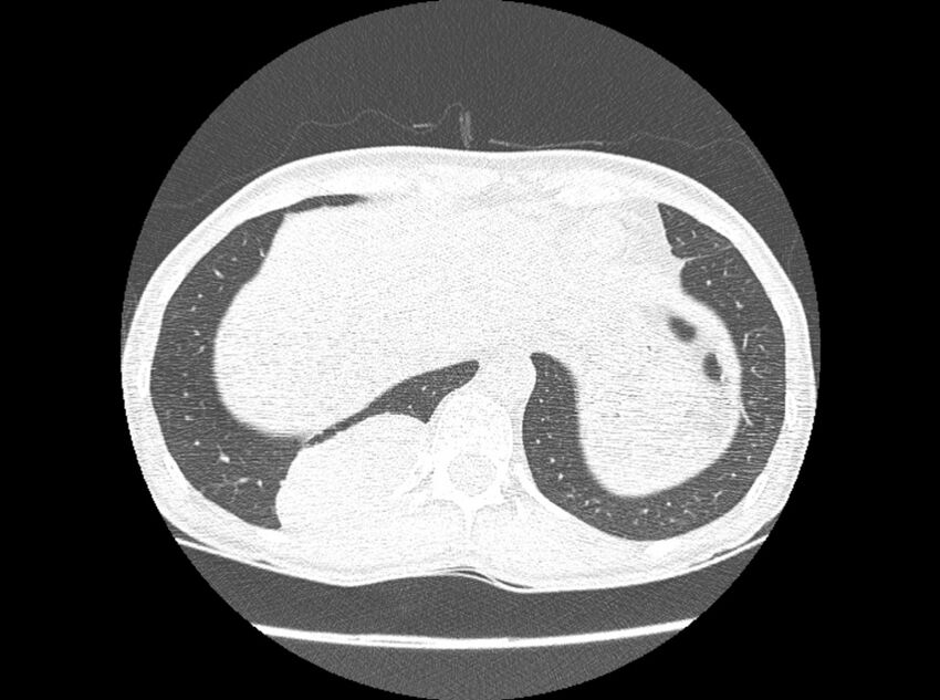Bronchogenic cyst (Radiopaedia 80273-93615 Axial lung window 30).jpg