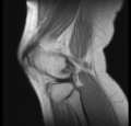 Bucket handle tear - medial meniscus (Radiopaedia 24900-25163 Sagittal T2 14).png