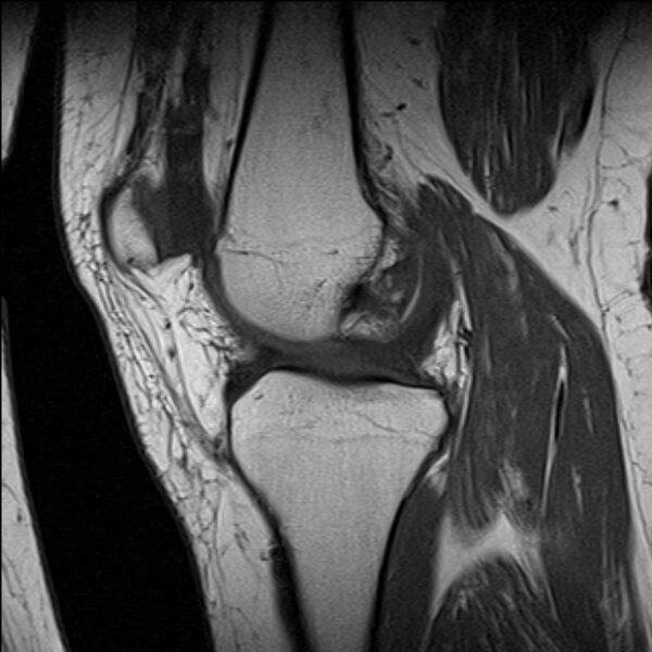 File:Bucket handle tear - medial meniscus (Radiopaedia 79028-91942 Sagittal T1 15).jpg