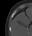 Buckle rib fractures (Radiopaedia 16349-16034 Axial bone window 1).jpg