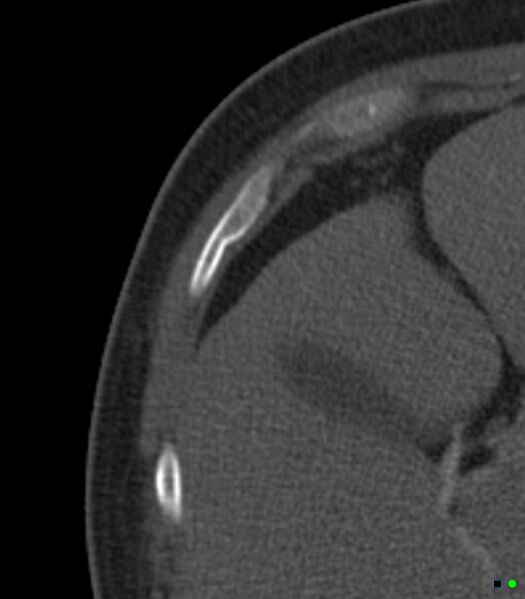 File:Buckle rib fractures (Radiopaedia 16349-16034 Axial bone window 1).jpg