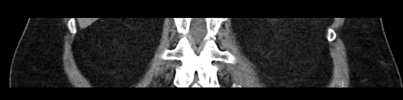 File:Buried bumper syndrome - gastrostomy tube (Radiopaedia 63843-72575 Coronal Inject 78).jpg