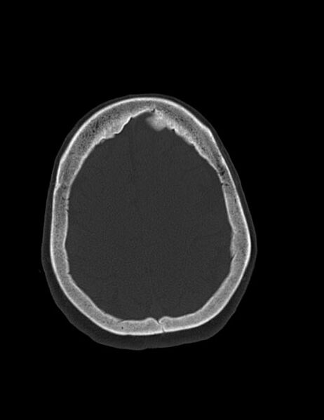 File:Burnt-out meningioma (Radiopaedia 51557-57337 Axial bone window 38).jpg