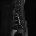 Burst fracture - lumbar spine (Radiopaedia 72877-83541 Sagittal STIR 7).jpg