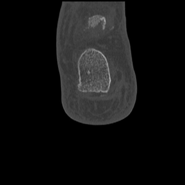 File:Calcaneal tuberosity avulsion fracture (Radiopaedia 22649-22668 Coronal bone window 62).jpg