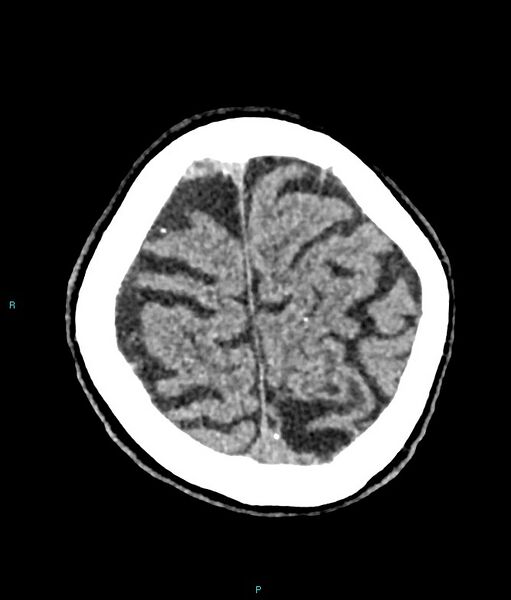 File:Calcified cerebral emboli from left ventricular thrombus (Radiopaedia 84420-99758 Axial non-contrast 18).jpg