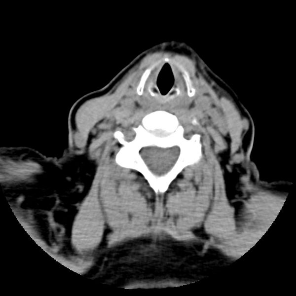 File:Calcified meningioma - cervical canal (Radiopaedia 70136-80171 B 24).jpg
